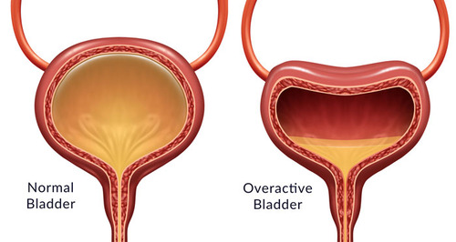 Overactive Bladder Treatment
